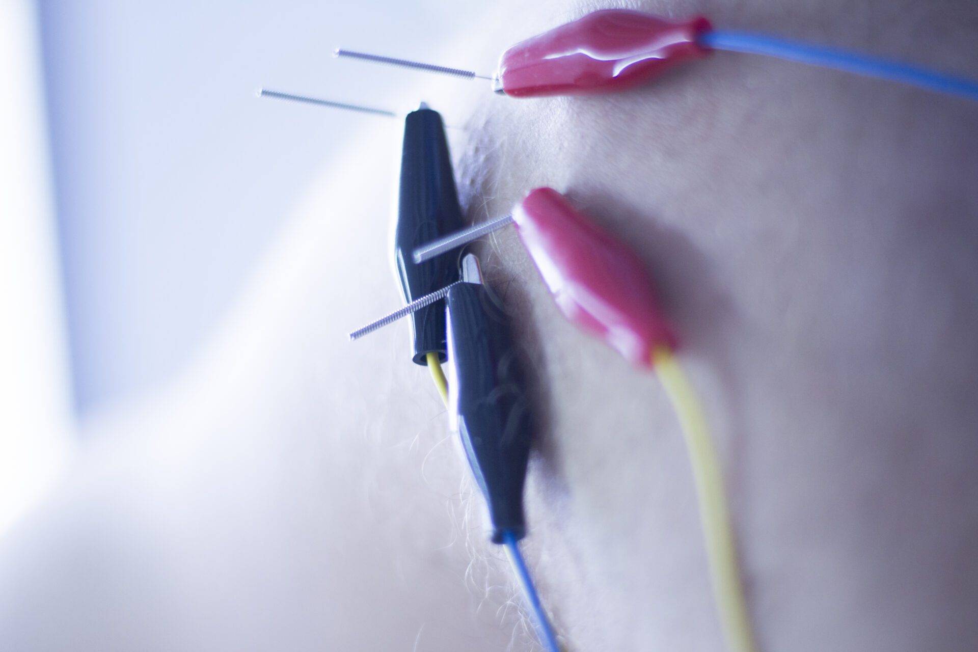 Dry needling electroacupunture needles used by acupunturist physiotherapist on patient in pain and injury acupunture with electrical pulse treatment.